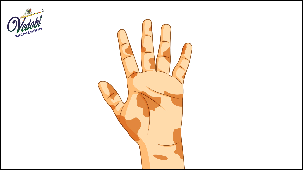 Know the Causes, Symptoms and Diagnosis of Leprosy